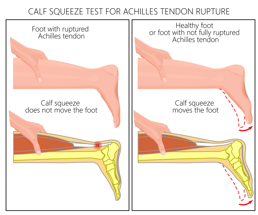 Calf squeeze test for Achilles tendon rupture — diagram showing positive and negative results